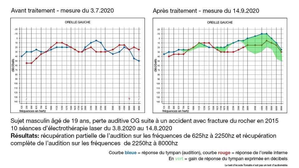 Résultats de notre traitement d'électrothérapie sur une fracture du rocher